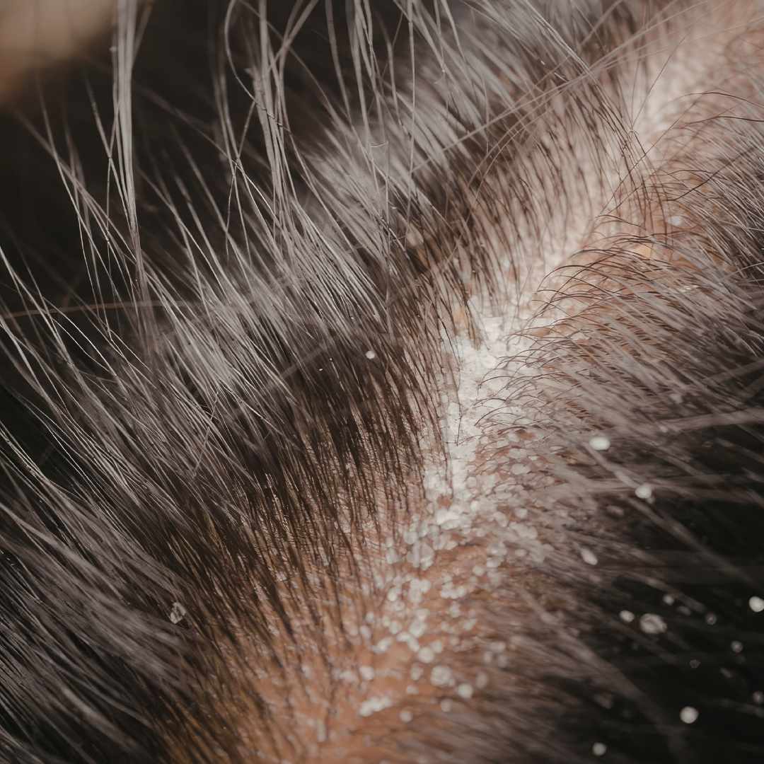 Bedste shampoo til tør hovedbund